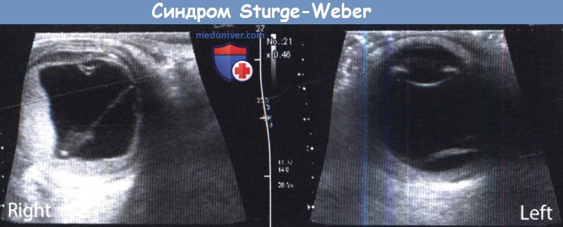    Sturge-Weber