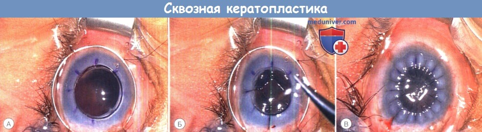 Сквозная кератопластика при аномалии переднего сегмента глаза
