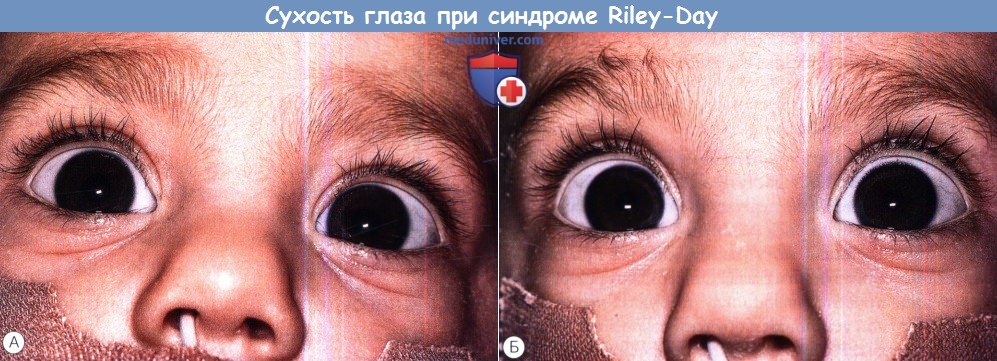 Сухость глаза при синдроме Riley-Day