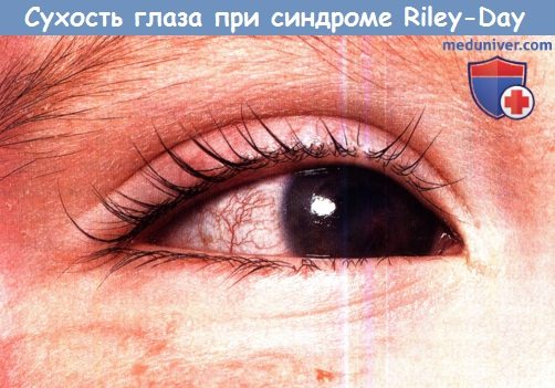 Сухость глаза при синдроме Riley-Day