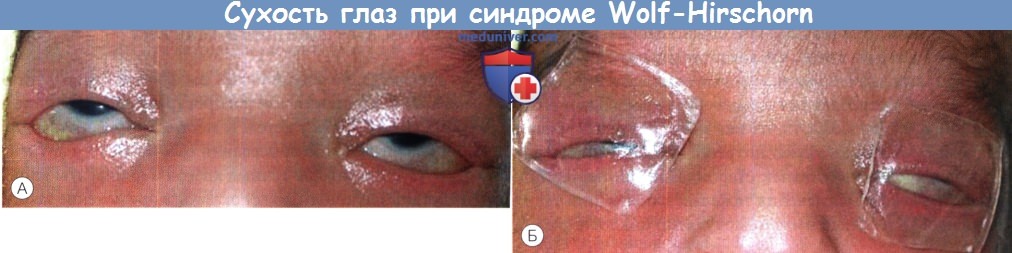 Сухость глаз при синдроме Wolf-Hirschorn