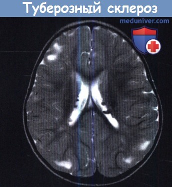Туберозный склероз - МРТ мозга