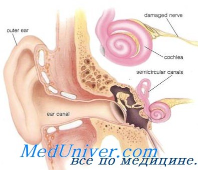 нейросенсорная глухота