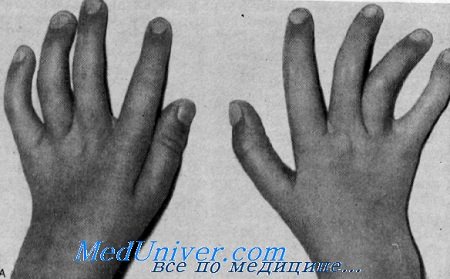 глухота с артрогриппозной аномалией рук