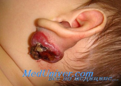опухоль уха у детей