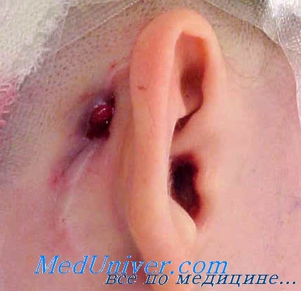 Может ли болеть ухо при сифилисе thumbnail