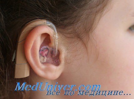 отечественные слуховые аппараты