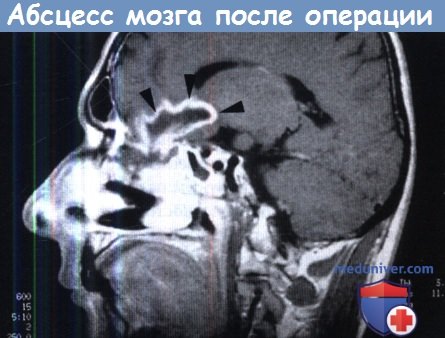 Абсцесс мозга после операции