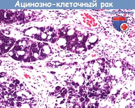 Цитология (гистология) слюнной железы при ацинозно-клеточном раке
