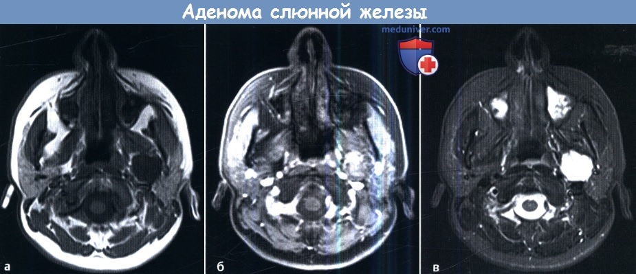 МРТ при аденоме слюнной железы