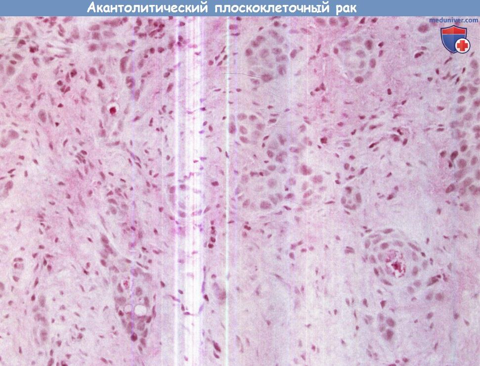 Цитология (гистология) биопсии гортани при акантолитическом плоскоклеточном раке