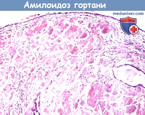 Цитология (гистология) амилоидоза гортани