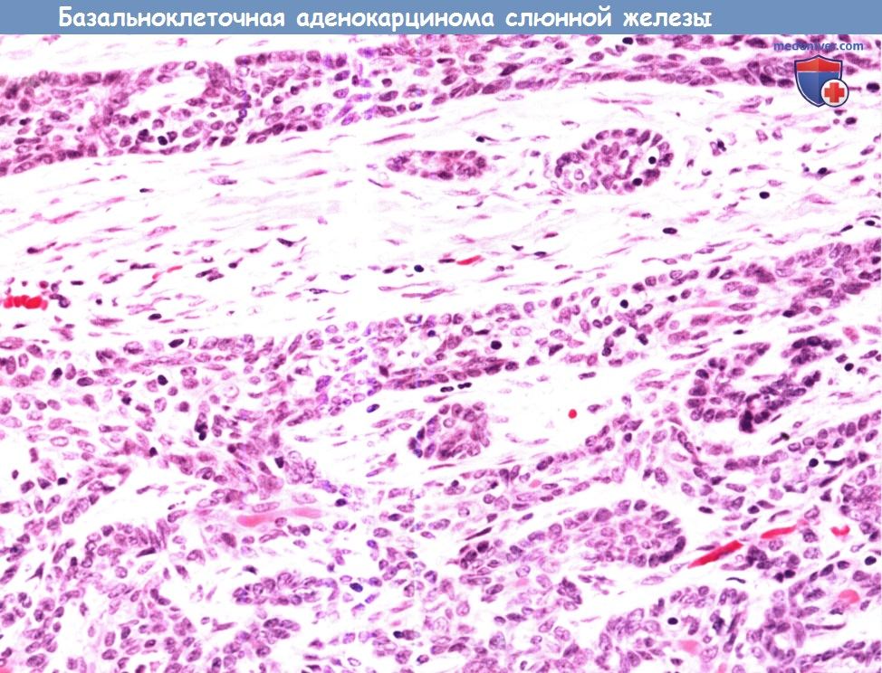Цитология (гистология) слюнной железы при базальноклеточной карциноме