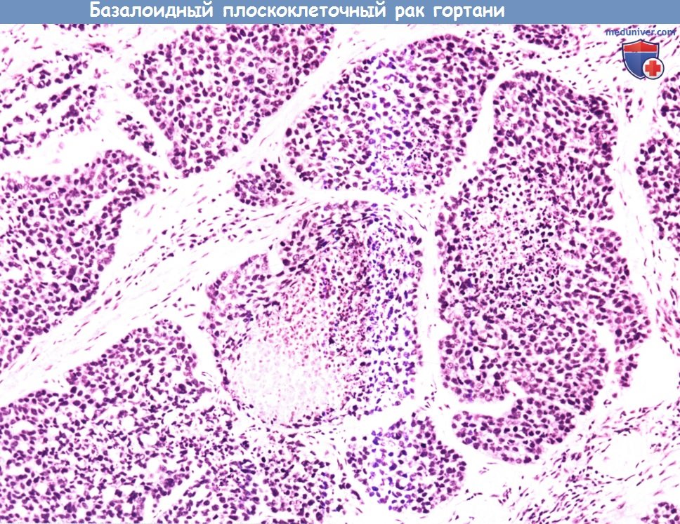 Цитология (гистология) биопсии гортани при базалоидном плоскоклеточном раке