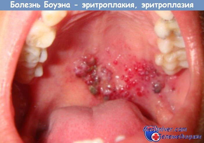 Симптомы эритроплазии (эритроплакии, болезни Боуэна) полости рта