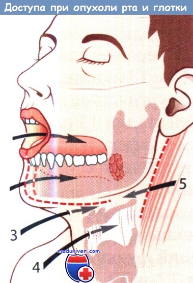 Доступы при опухоли рта и глотки