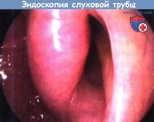 Эндоскопия слуховой трубы