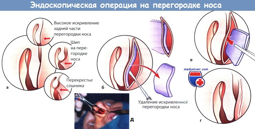 Эндоскопическая операция на перегородке носа