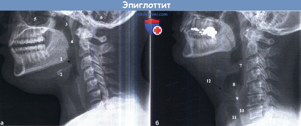 Рентгенограмма при эпиглоттите
