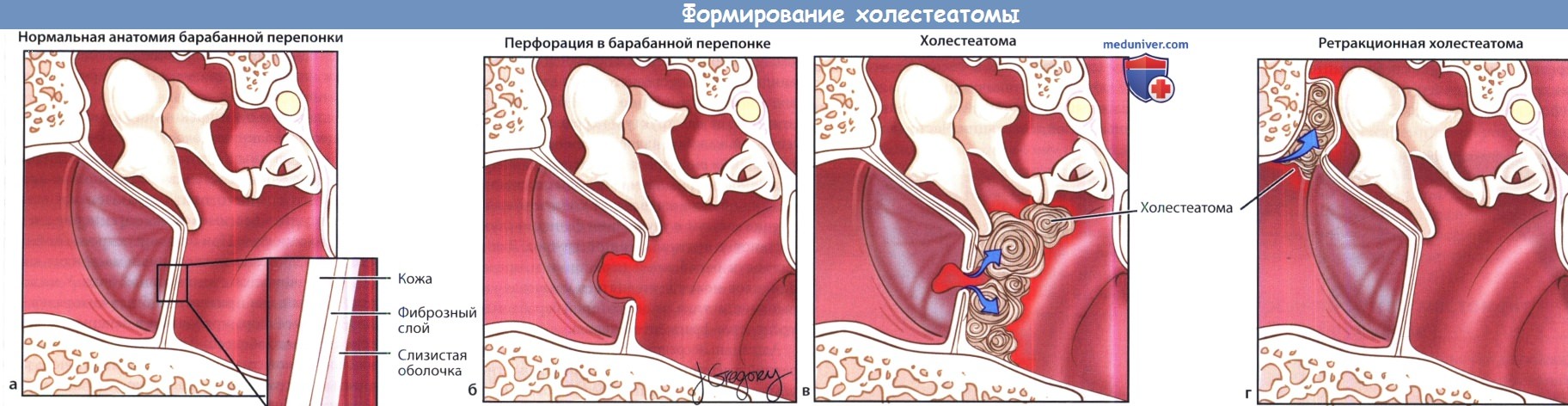 Формирование холестеатомы