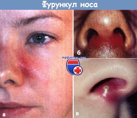Лечение фурункула в носу - ЛОР клиника №1
