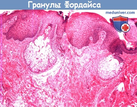 Цитология (гистология) полости рта при гранулах Фордайса