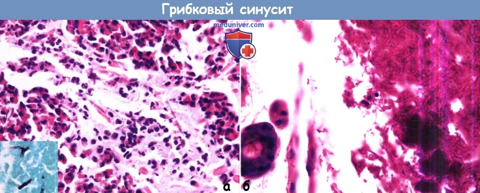 Цитология (гистология) при грибковом синусите