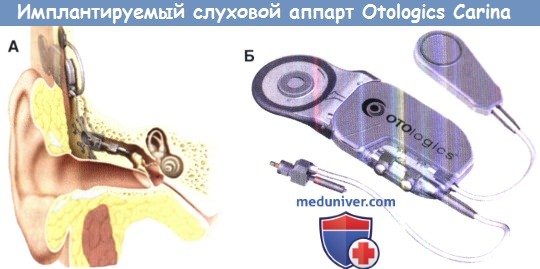 Имплантируемый слуховой аппарат Otologics Carina