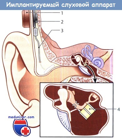 Имплантируемый слуховой аппарат