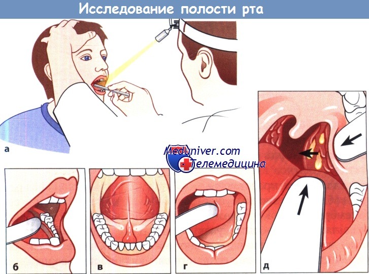 Исследование полости рта и миндалин