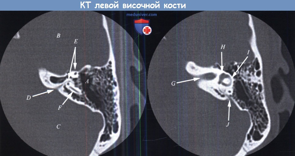 КТ левой височной кости