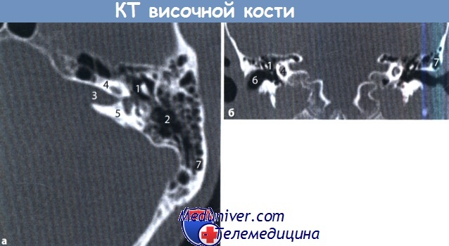 Компьютерная томография (КТ) височной кости при болезни уха