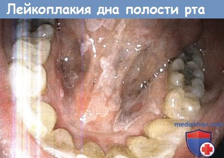 Лейкоплакия дна полости рта
