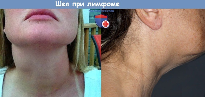 Лимфома Ходжкина — первые признаки и симптомы, лечение лимфогранулематоза в Москве
