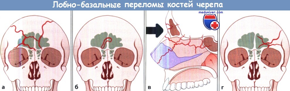 Лобно-базальные переломы костей черепа
