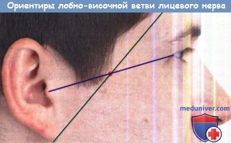 Ориентиры лобно-височной ветви лицевого нерва