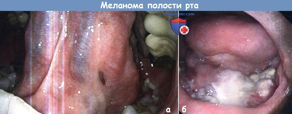 Меланома полости рта