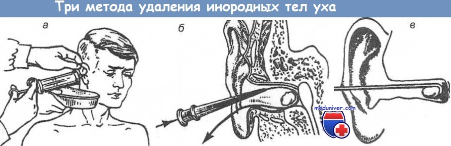 Методы удаления инородных тел уха