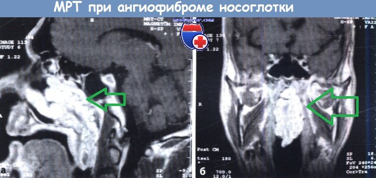 МРТ при ангиофиброме носоглотки