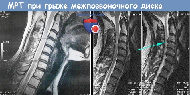 МРТ при грыже межпозвоночного диска и шейного синдрома из-за него