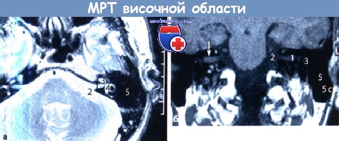 МРТ височной кости при болезни уха