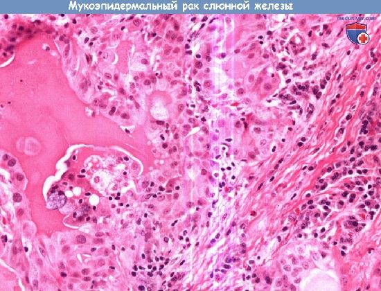 Цитология (гистология) слюнной железы при мукоэпидермальном раке слюнной железы