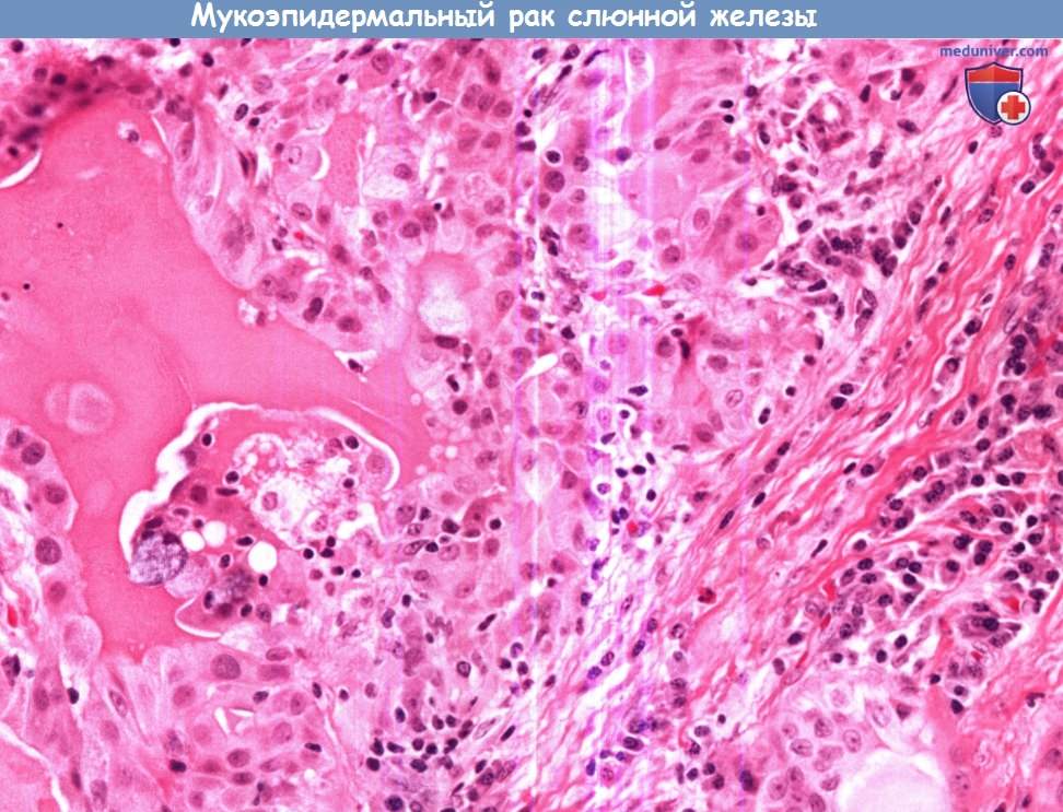 Цитология (гистология) слюнной железы при мукоэпидермальном раке слюнной железы