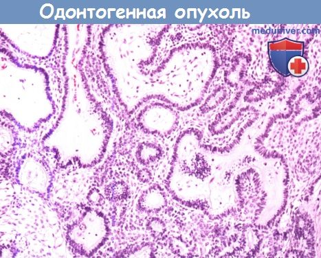 Цитология (гистология) одонтогенной опухоли - амелобластомы