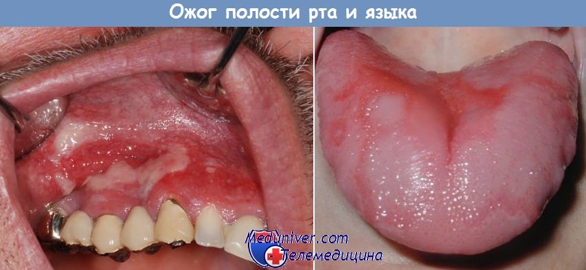 Ожог полости рта и языка
