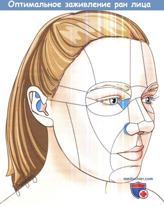 optimalnoe zagivlenie ran lica