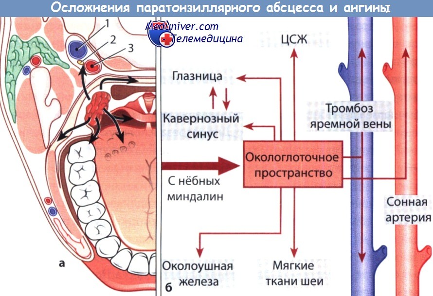 Осложнения паратонзиллярного абсцесса и ангины