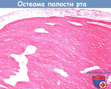 Цитология (гистология) полости рта при остеоме полости рта