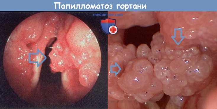Симптомы папилломатоза гортани и его лечение