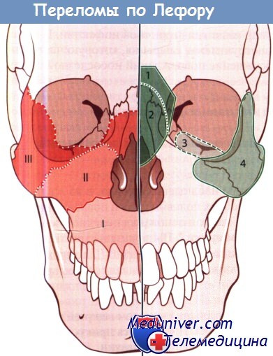 Переломы лицевого отдела черепа по Лефору